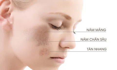 Top 3 sai lầm kinh điển khi điều trị nám!