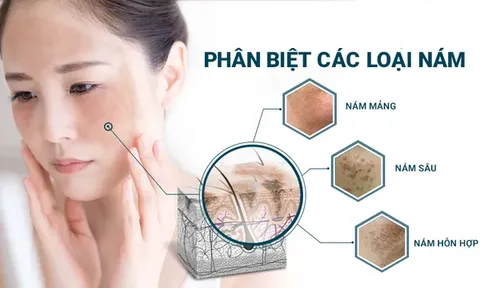 Cách phân biệt tàn nhang và nám chân sâu