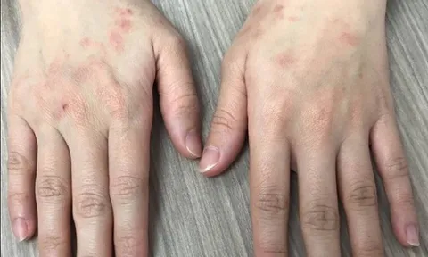 Cảnh báo tác hại của việc lạm dụng nước rửa tay khô