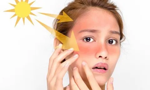 4 bí quyết chữa cháy nắng cho da từ thiên nhiên cực đơn giản, bạn có biết?