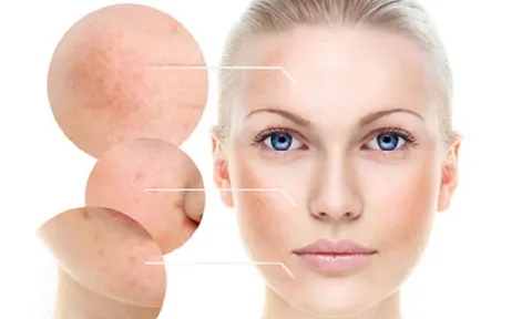Trị sạch nám lâu năm chỉ tốn 2 nghìn đồng mỗi ngày