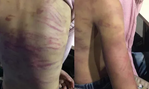 Hà Nội: Bé gái 12 tuổi nghi bị mẹ đẻ và người tình bạo hành