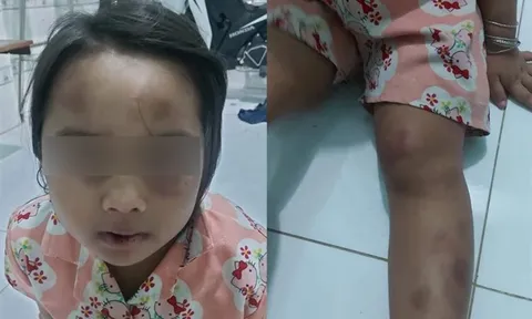 Bình Dương: Tạm giữ vợ chồng cô ruột bạo hành cháu gái 6 tuổi