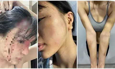 Công an vào cuộc điều tra vụ nữ siêu mẫu tố bị bạn trai hành hung