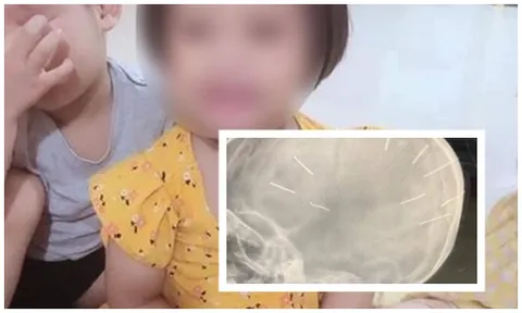 Vụ cháu bé 3 tuổi bị đinh găm vào sọ: Cục Trẻ em đề nghị xử nghiêm
