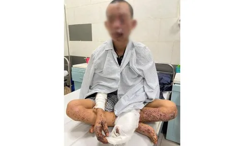 Dùng điện thoại khi đang sạc, nam thanh niên bị cháy sém toàn thân, nguy cơ mù
