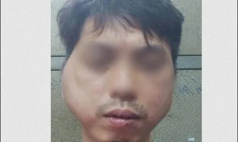 Thanh niên tố bị chủ quán lẩu nướng ở Hà Nội đánh biến dạng khuôn mặt