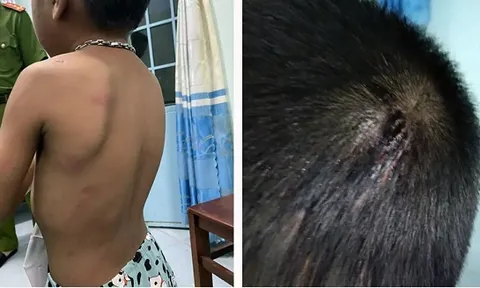 Bắt tạm giam người cha nhiều lần đánh đập, hành hạ con trai 6 tuổi