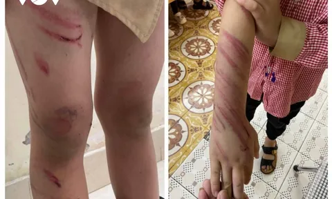 Hải Phòng: Bé trai 8 tuổi nghi bị bạn trai của mẹ đánh bầm tím khắp người