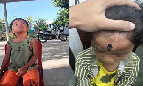 Khởi tố cha dượng hành hạ con riêng của vợ ở Kiên Giang