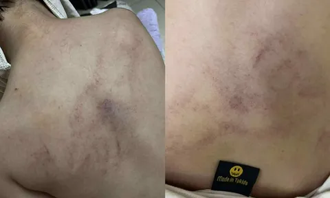 Điều tra vụ bé gái 4 tuổi bị giáo viên mầm non đánh đập, kéo lê, ném vào tường ở Hà Nội
