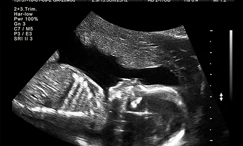 Luật Dân số: Bác sĩ tiết lộ giới tính thai nhi sẽ bị đình chỉ hành nghề