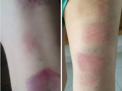 Xử lý nghiêm vụ 22 học sinh lớp 8 bị giáo viên đánh bầm tím chân