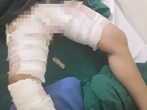 Bác sỹ sơ ý trong quá trình phẫu thuật khiến cồn làm bỏng bệnh nhân