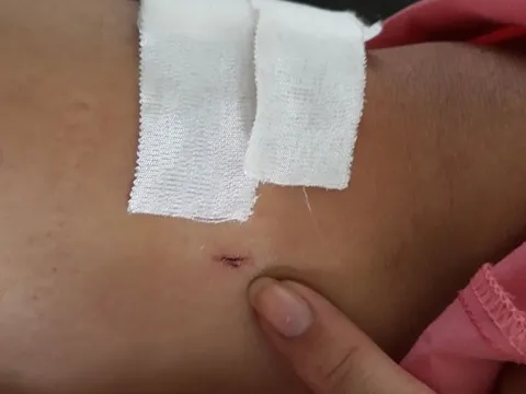 Đình chỉ 2 nhân viên bệnh viện vì khoan nhầm chân bệnh nhân ở bệnh viện Chợ Rẫy