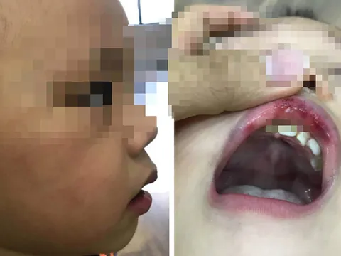 Thông tin mới vụ cô giáo tát trẻ 3 tuổi bầm tím mặt, tụ máu môi