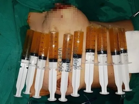 Người mẹ trẻ hú hồn vì ngực trái sưng to 50cm sau 'nâng cấp'