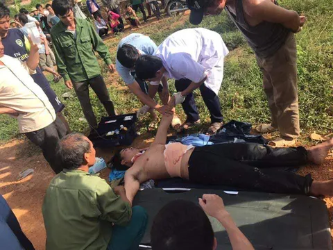 Vì nghĩ trong bụng có bom, người đàn ông lấy dao tự rạch bụng