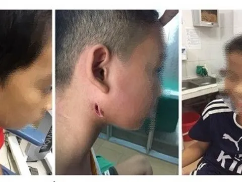 Biểu hiện bệnh, con đường lây truyền và cách phòng ngừa vi khuẩn 'ăn thịt người'