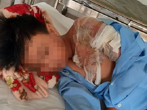 Thanh Hóa: Bé trai 11 tuổi bị cha tạt nước sôi
