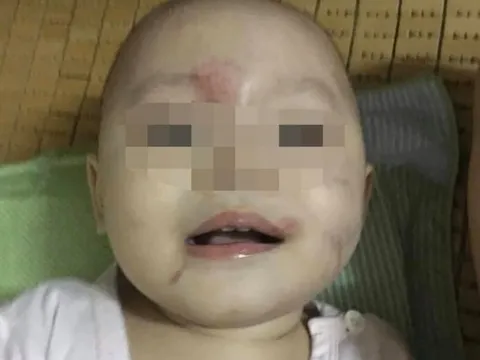 Thông tin chính thức vụ bé gái 14 tháng tuổi bị bầm tím vùng mặt ở Hải Phòng
