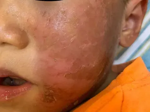 Bé 4 tuổi bỏng rộp da mặt vì đeo mặt nạ hóa trang Halloween