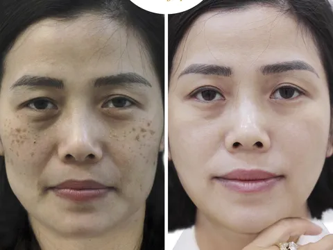 Chị khách U35 vỡ òa hạnh phúc khi trị nám thành công tại nhà với phác đồ Bích Nguyệt Lullaby