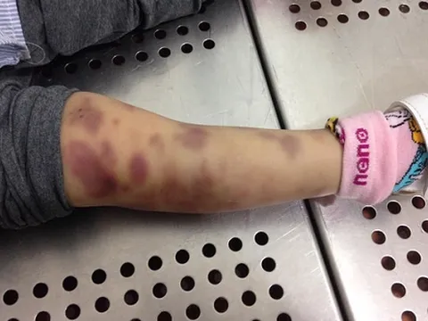 Tình tiết mới vụ bé gái 3 tuổi tử vong nghi do mẹ và bố dượng bạo hành