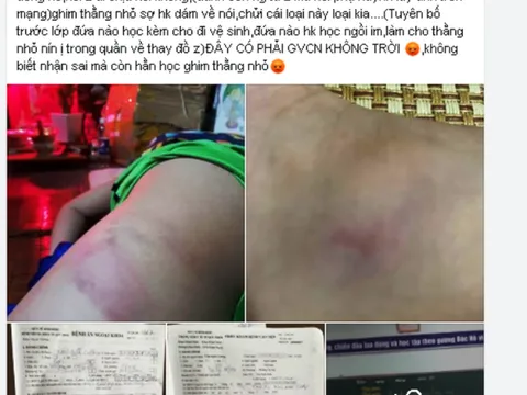 Giáo viên chủ nhiệm bị phụ huynh tố cáo đánh học sinh bầm tím