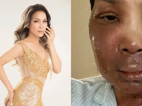 Hồng Ngọc bất ngờ công khai hình ảnh bị bỏng 2/3 gương mặt vì nổ nồi xông hơi
