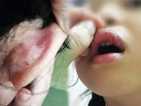 Điều tra vụ phụ huynh tố cô giáo chủ nhiệm tát chảy máu mồm học sinh vì làm toán sai