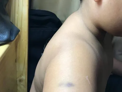 Phụ huynh tố cô giáo trường Quốc tế Á Châu đánh học sinh bầm tím tay