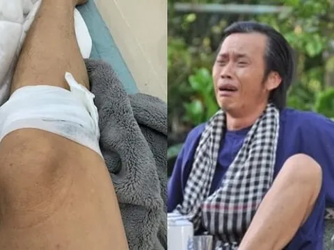 Hoài Linh bị vật nuôi 'phản chủ' đá đến bị thương băng bó ở chân