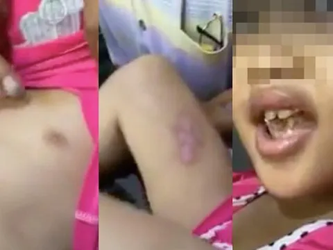 Sắp xét xử cha dượng đánh đập, châm điếu thuốc vào người bé gái ở TP.HCM