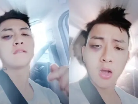 Hoài Lâm gây chú ý với gương mặt bầm tím