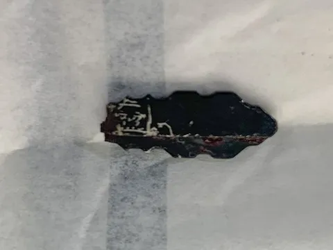 Đầu chìa khóa sắt hoen rỉ nằm trong tai thanh niên suốt 1 năm