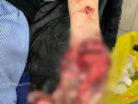 Yên Bái: Điện thoại phát nổ khi đang sạc, nam sinh dập nát bàn tay