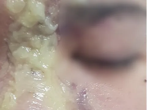 Thiếu nữ 15 tuổi bị mù vĩnh viễn sau tiêm filler nâng mũi giá 1,5 triệu