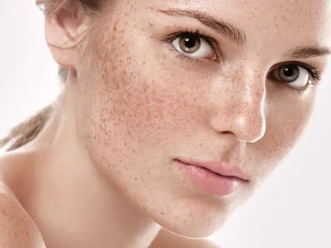 Trị nám bằng laser có tốt không?