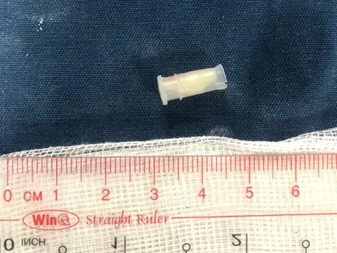 Bé 3 tuổi tắc thở, tím tái người vì còi đồ chơi chui vào phế quản