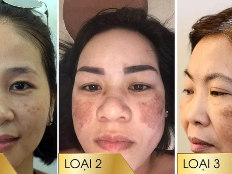 Nám hai bên gò má có chữa khỏi hoàn toàn được không?