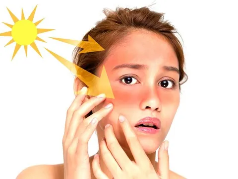 5 mẹo hay giúp bạn đánh bật nám da cực hiệu quả từ thói quen sinh hoạt hằng ngày!