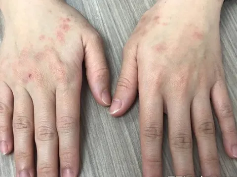 Cảnh báo tác hại của việc lạm dụng nước rửa tay khô