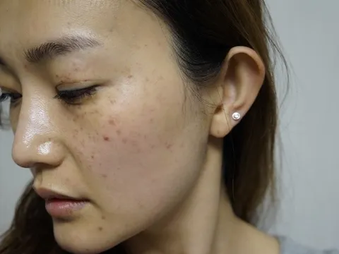 Vì sao phụ nữ Việt lại dễ bị nám?