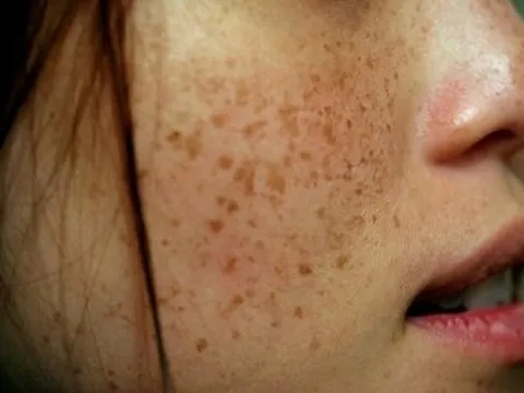 Nám chân sâu là gì? Có cách nào trị dứt điểm được không?