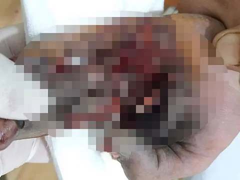 Chơi game trong lúc sạc điện thoại, thiếu niên bị nổ nát bàn tay