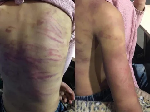 Hà Nội: Bé gái 12 tuổi nghi bị mẹ đẻ và người tình bạo hành