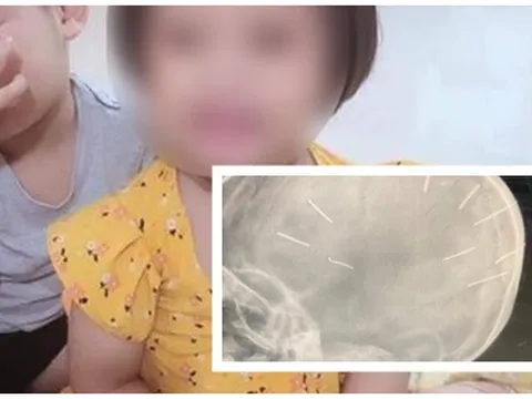 Vụ cháu bé 3 tuổi bị đinh găm vào sọ: Cục Trẻ em đề nghị xử nghiêm