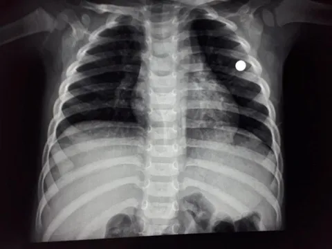 Thanh Hóa: Anh nghịch súng tự chế bắn trúng ngực em trai