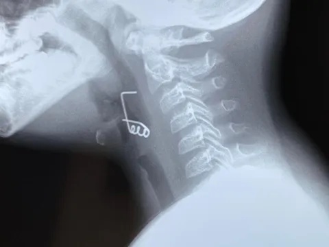 TP.HCM: Bé trai 9 tuổi nuốt lò xo vào cổ họng